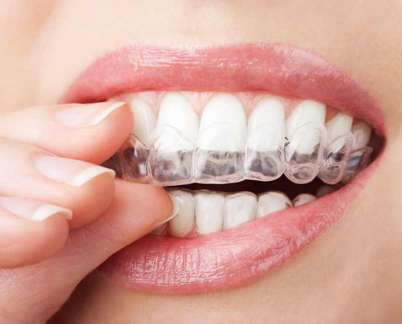 Keep On Smiling with An Invisalign Dentist in Lafayette LA