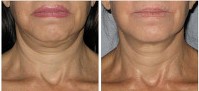 The Benefits of Considering Non-Invasive Options for Neck Tightening in East Hampton NY