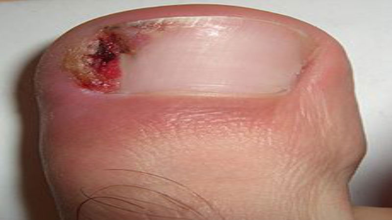 Getting Help for Unsightly Nails from a Toenail Doctor