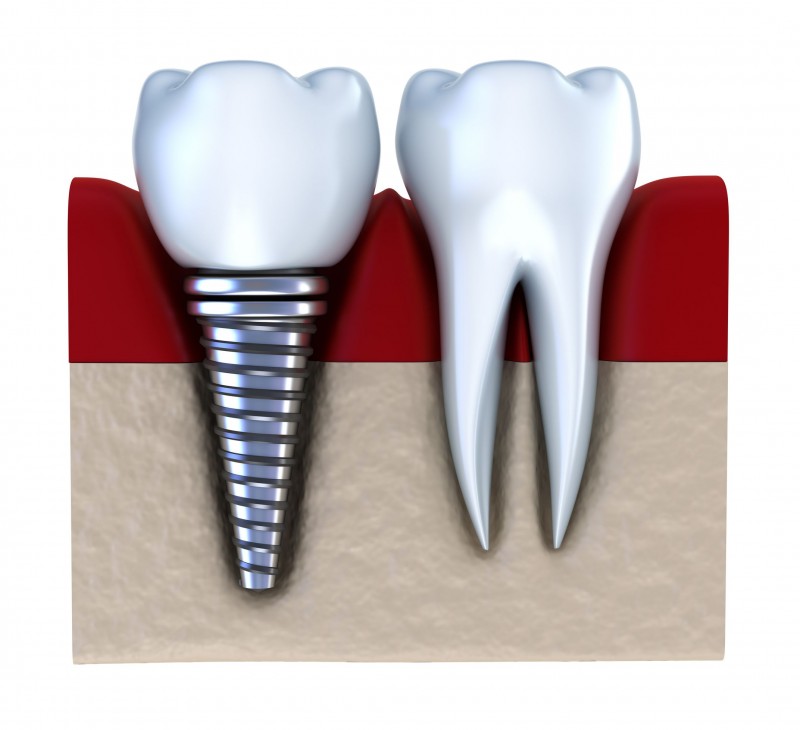 Dental Implants in Short Hills, NJ Information