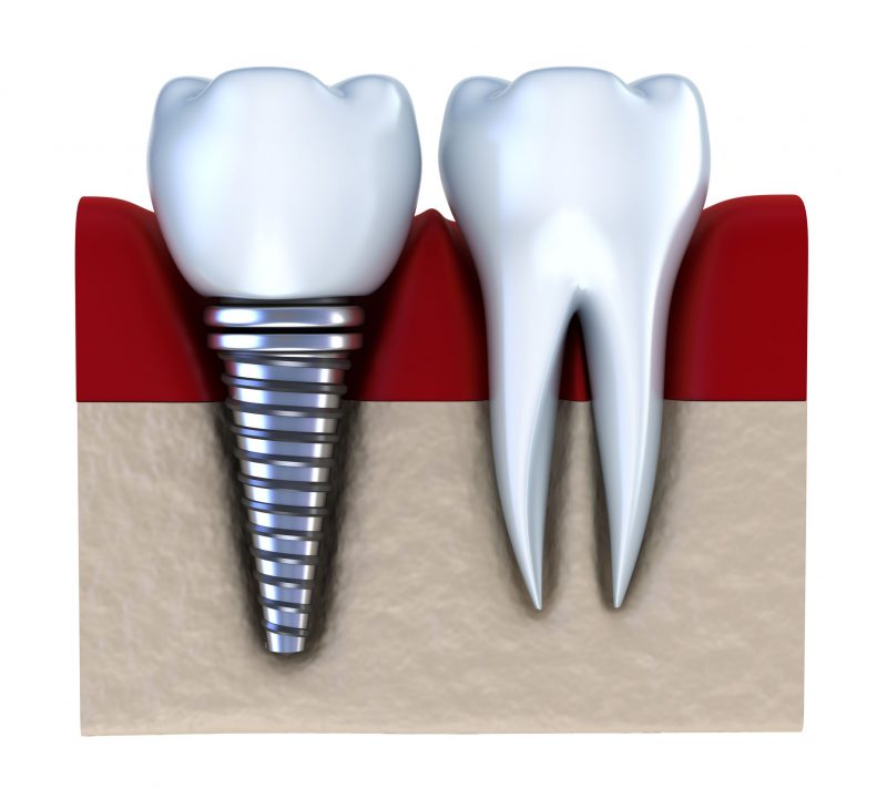 Benefits Offered by Dental Implants in Kona