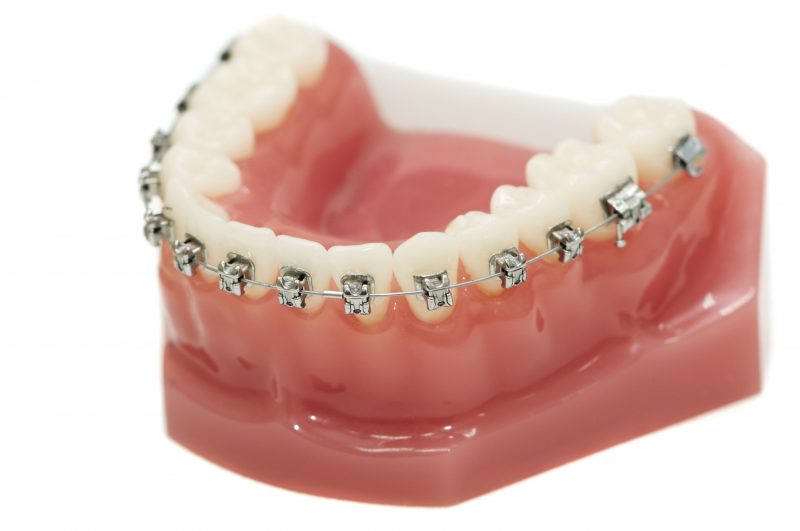 Metal Braces vs Invisalign In California MD