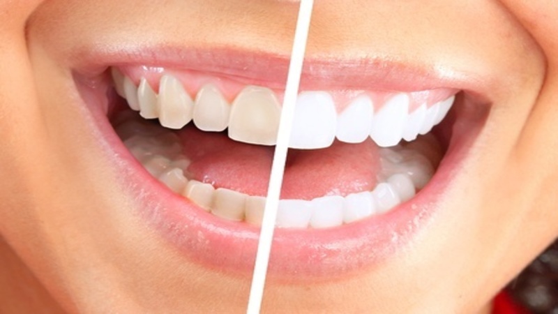 You Can Always Rely on Professional Teeth Whitening in Topeka, KS for Expert Results