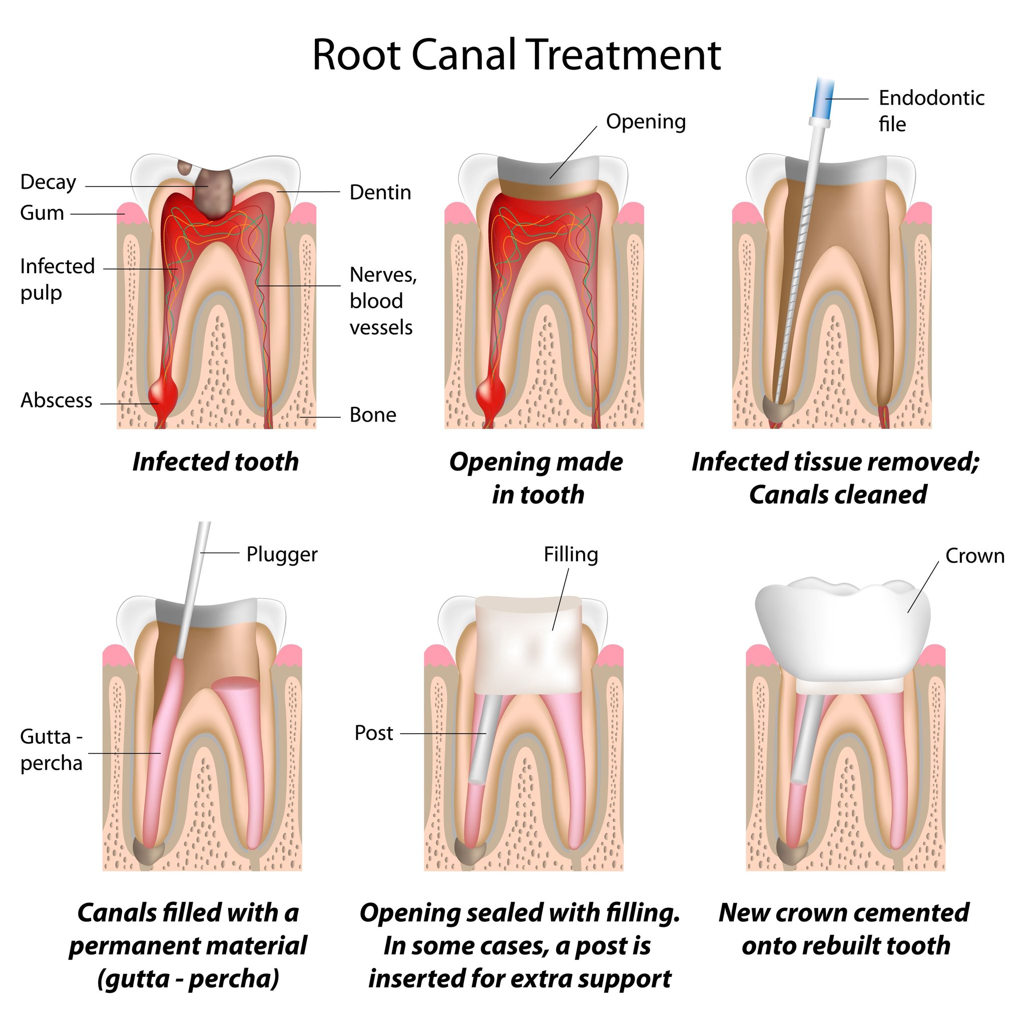 Frequently Asked Questions About Root Canal Therapy In Camas WA