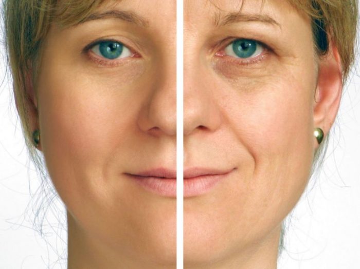 Should You Get a Facelift, Find a Surgeon in Chicago